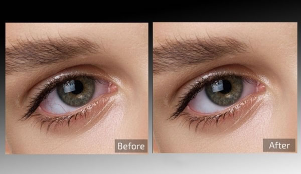 Retouch4me Eye Vessels-ͼƬ-Retouch4me Eye Vessels v0.9.9.3ٷʽ